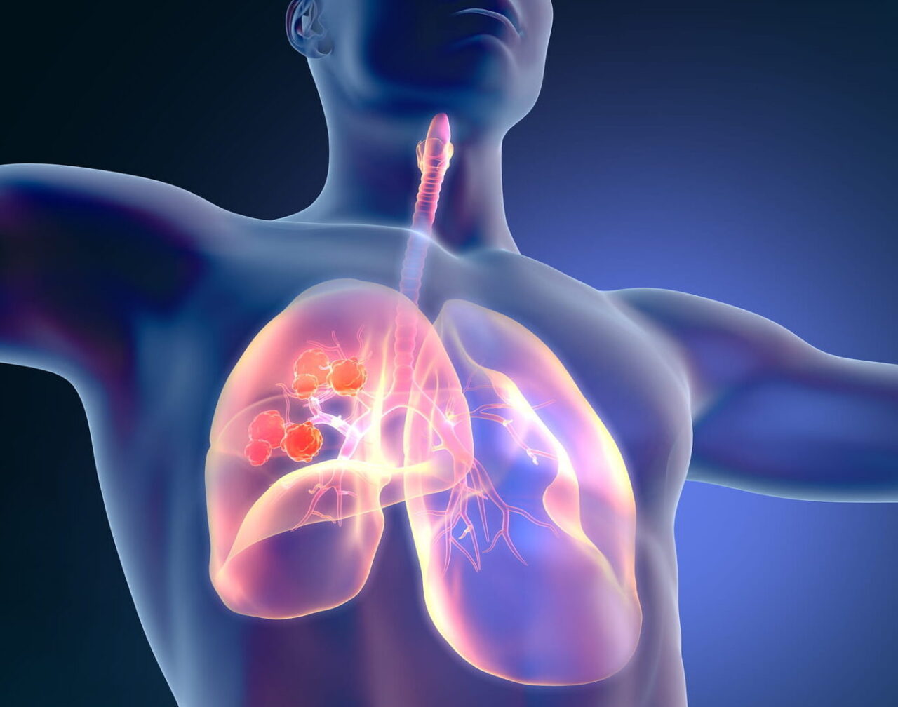 Quelle est la chance de survie pour le cancer du poumon ?